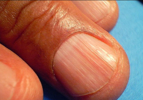 Por qué aparecen estrías en las uñas Tu vida se encuentra en peligro